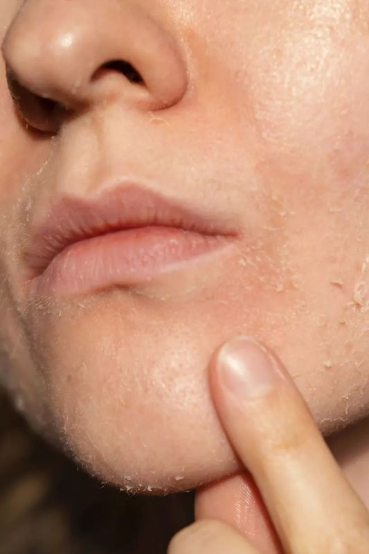 Dehydrated Skin vs Dry Skin Understanding the Difference